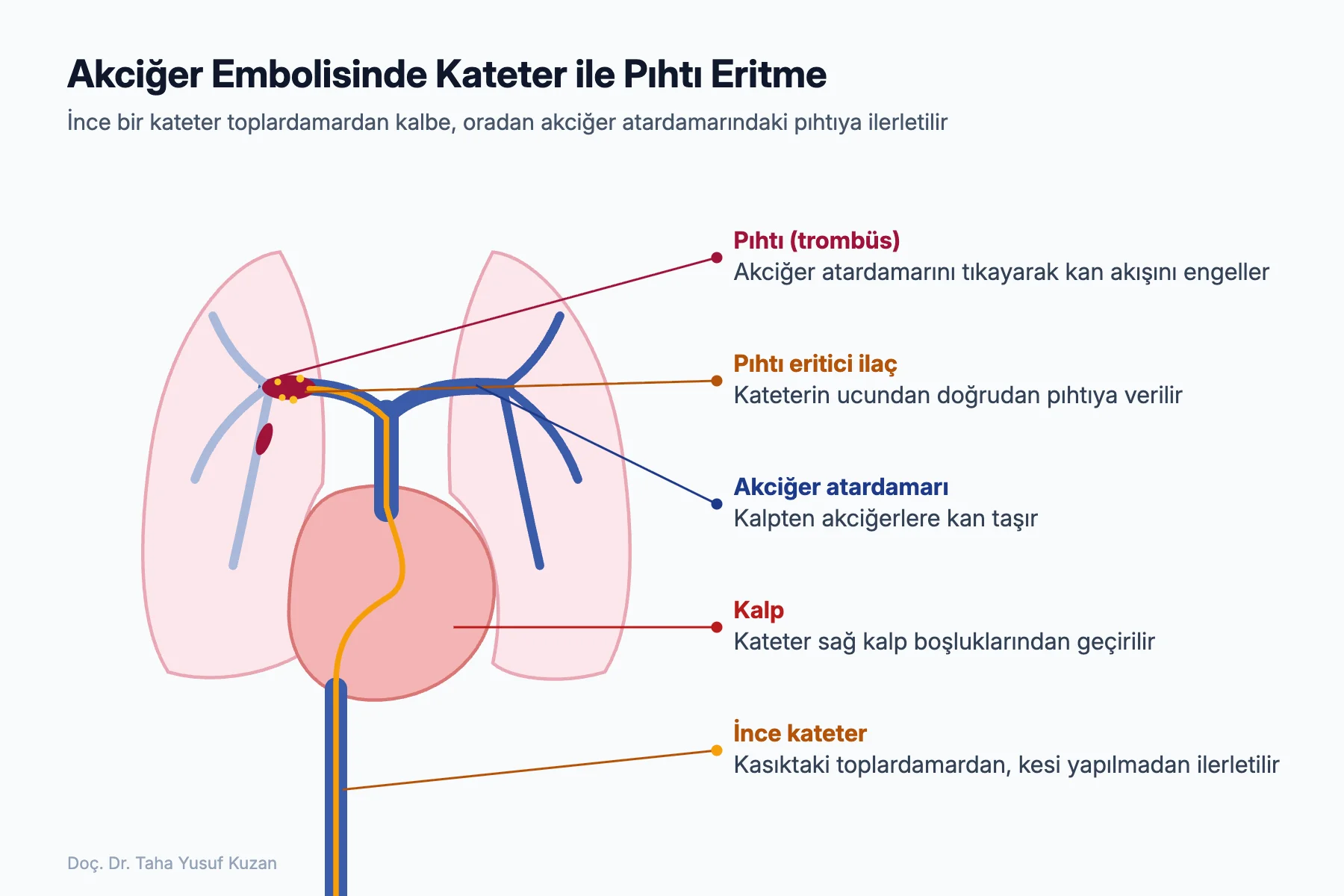 Akciğer embolisi tedavisinde kasıktaki toplardamardan ilerletilen kateter ile akciğer atardamarındaki pıhtının eritilmesi şeması