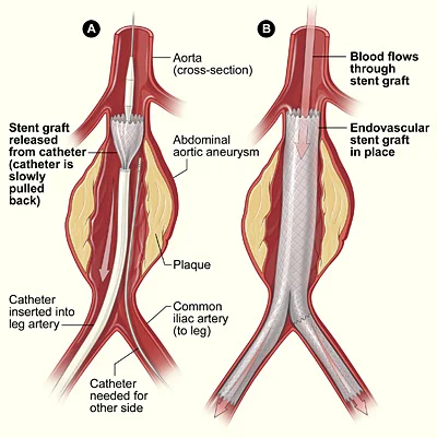 Anevrizma tedavisi: EVAR ile karın aort anevrizmasına stent greft yerleştirilmesi
