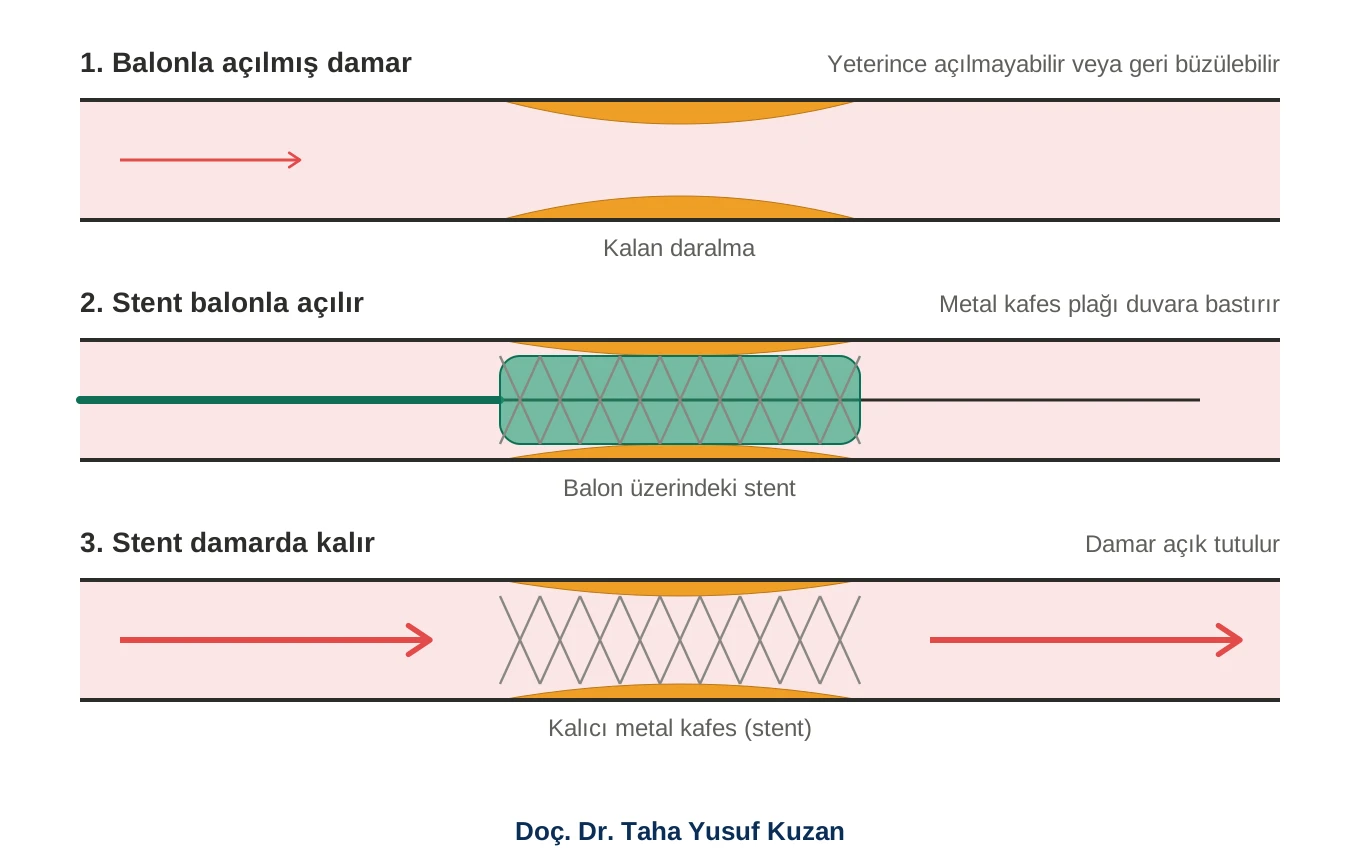 Bacak damarına stent yerleştirme adımları