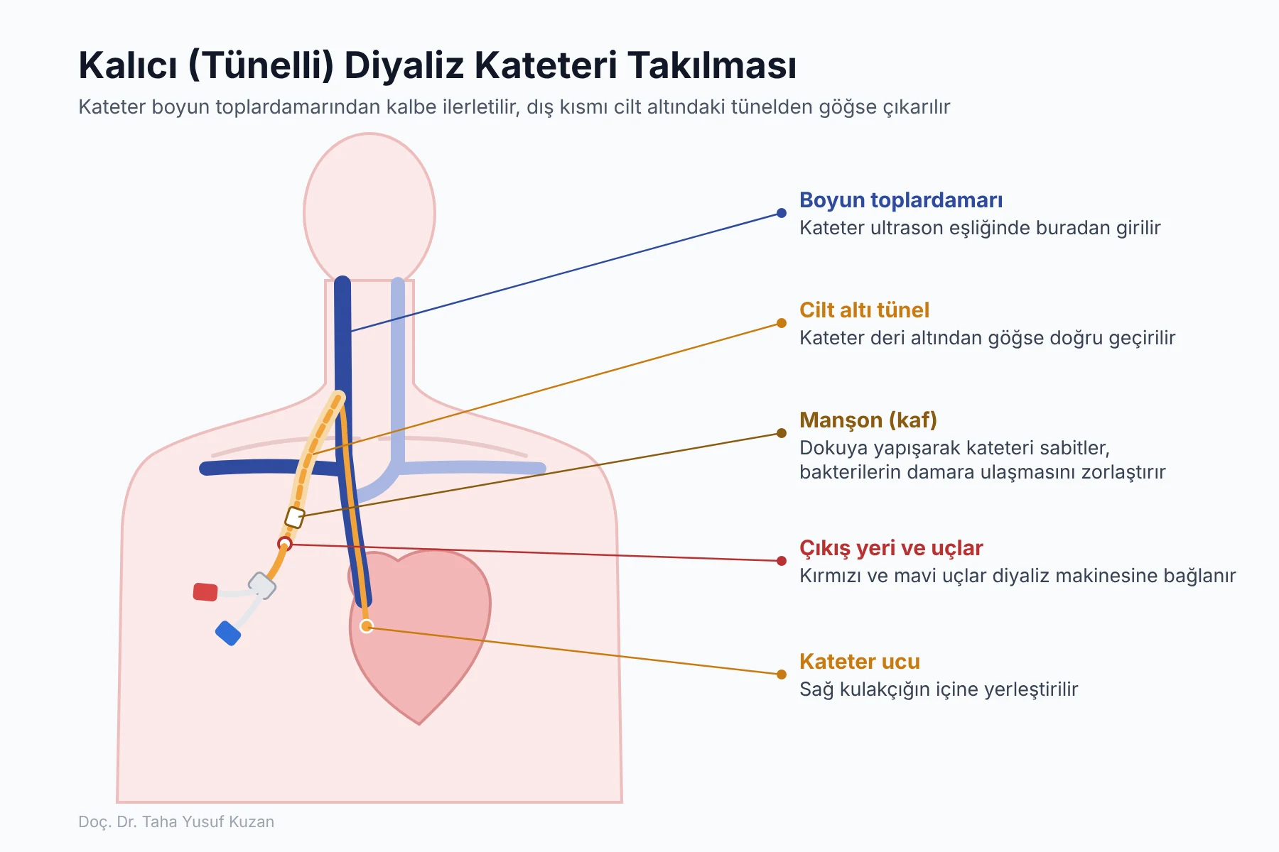 Kalıcı tünelli diyaliz kateterinin boyun toplardamarından girilerek ucunun sağ kulakçığa yerleştirilmesini ve göğüste cilt altı tünelden çıkışını gösteren şema